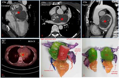 Case Report: 3D Printing Guided Cardiac Autotransplantation for Treatment of a Giant Complex Primary Left Atrial Tumor